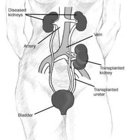 A diagram illustrating a typical kidney transplant such as the ones Woodruff performed in Edinburgh