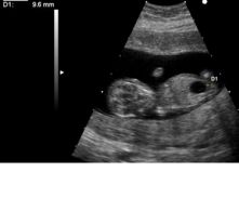 Ultrasound of fetus with Down syndrome and megacystis.