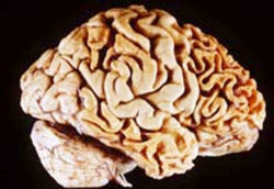 A human brain showing frontotemporal lobar degeneration causing frontotemporal dementia.