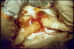 Coronary artery bypass surgery during mobilization (freeing) of the right coronary artery from its surrounding tissue, adipose tissue (yellow).  The tube visible at the bottom is the aortic cannula (returns blood from the HLM).  The tube above it (obscured by the surgeon on the right) is the venous cannula (receives blood from the body).  The patient's heart is stopped and the aorta is cross-clamped.  The patient's head (not seen) is at the bottom.