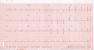 12-lead electrocardiogram (ECG) showing acute inferior ST segment elevation MI (STEMI). Note the ST segment elevation in leads II, III, and aVF along with reciprocal ST segment depression in leads I and aVL.