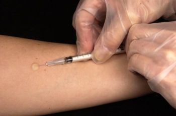 Mantoux tuberculin skin test.