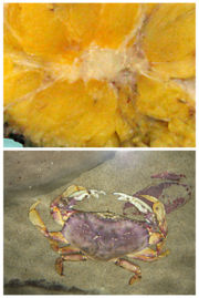 Breast cancer in a mastectomy specimen (top). The cancerous tumour (pale yellow) resembles the figure of a crab, giving the disease its name.