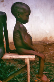 A child with kwashiorkor during the Nigerian Civil War.