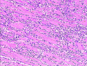 Microscopy image (magn. ca 100x, H&E stain) from autopsy specimen of myocardial infarct (7 days post-infarction).