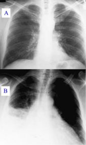 Pneumonia as seen on chest x-ray.  A: Normal chest x-ray. B: Abnormal chest x-ray with shadowing from pneumonia in the right lung (left side of image).