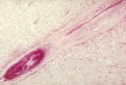 A blockage of the lumbar anterior spinal cord artery due to polio (PV3)