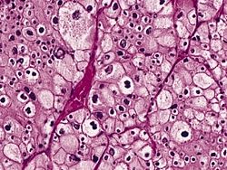 A renal cell carcinoma (chromophobe type) viewed on a hematoxylin & eosin stained slide