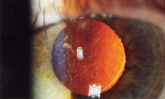 Image:Posterior capsular opacification on retroillumination.jpg