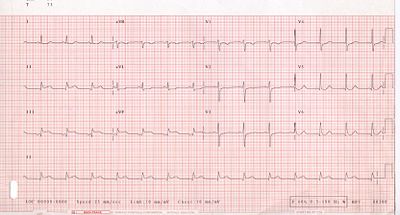 12-lead electrocardiogram (ECG) showing acute inferior ST segment elevation MI (STEMI). Note the ST segment elevation in leads II, III, and aVF along with reciprocal ST segment depression in leads I and aVL.