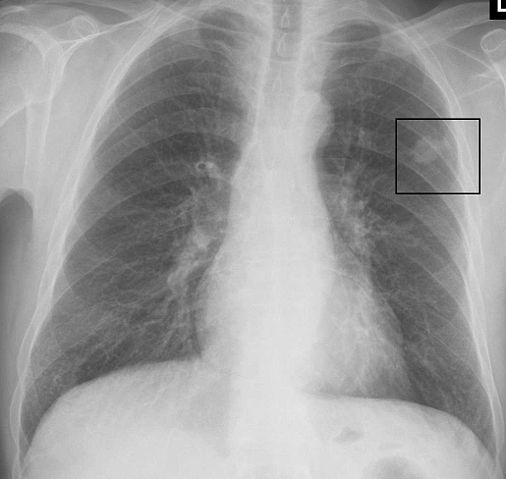 Image:Thorax pa peripheres Bronchialcarcinom li OF markiert.jpg