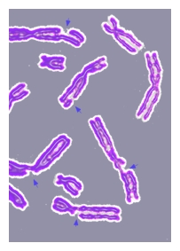 DNA damage resulting in multiple broken chromosomes