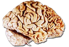 A human brain showing frontotemporal lobar degeneration causing frontotemporal dementia.