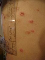 Erythema nodosum