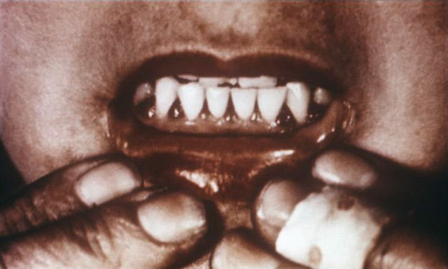 Image:Scorbutic gums.jpg