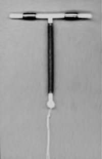 An intrauterine device.