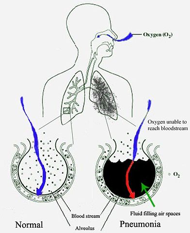 Image:New Pneumonia cartoon.jpg