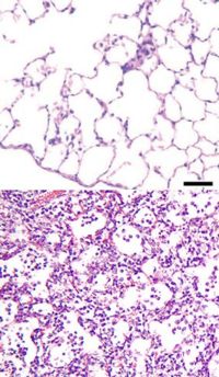 Upper panel shows a normal lung under a microscope. The white spaces are alveoli that contain air. Lower panel shows a lung with pneumonia under a microscope. The alveoli are filled with inflammation and debris.