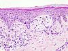 Malignant melanoma in skin biopsy with H and E stain.