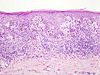 This case may represent superficial spreading melanoma.