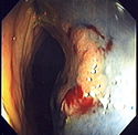 Endomucosal resection 2.jpg