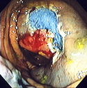 Endomucosal resection 3.jpg