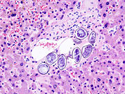 Schistosoma japonicum (3) histopathology.JPG