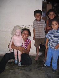 Albino girl honduras.jpg