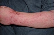 Atopic dermatitis child.JPG