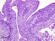 Bladder urothelial carcinoma (1) pT1.JPG