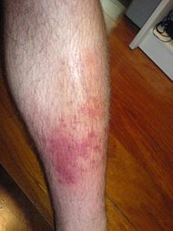 Cellulitis3.JPG