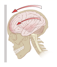 Concussion mechanics.svg