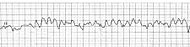 EKG VF.jpg