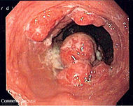 Esophageal adenoca.jpg