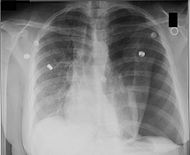 Pneumothorax CXR.jpg