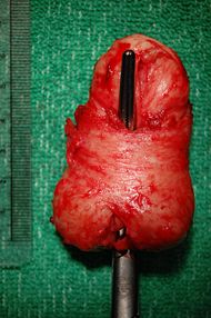 Prostate middle lobe orig.jpg