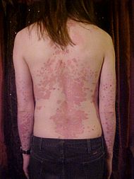 Psoriasis on back.jpg