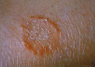 Ringworm on the arm, or tinea corporis due to Trichophyton mentagrophytes PHIL 2938 lores.jpg