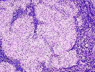 Sarcoidosis (1) lymph node biopsy.jpg