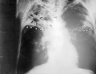 Tuberculosis-x-ray-1.jpg