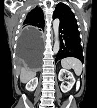 Tumor Mesothelioma2.JPG