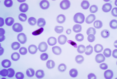 Blood smear of Plasmodium falciparum