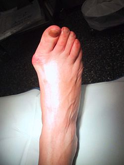 Hallux Valgus-Aspect pré op décharge.JPG