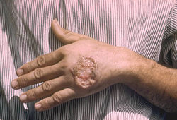 Skin ulcer due to leishmaniasis, hand of Central American adult 3MG0037 lores.jpg