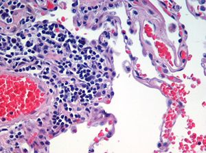 Emphysema H and E.jpg