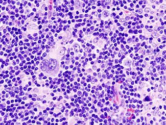 Hodgkin lymphoma (1) mixed cellulary type.jpg