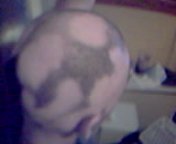 Alopecia areata head.jpg