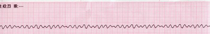 Lead II rhythm generated ventricular fibrilation VF.JPG