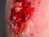 A ruptured MRSA abscess