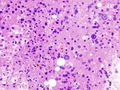 Hepatocellular carcinoma histopathology (1).jpg